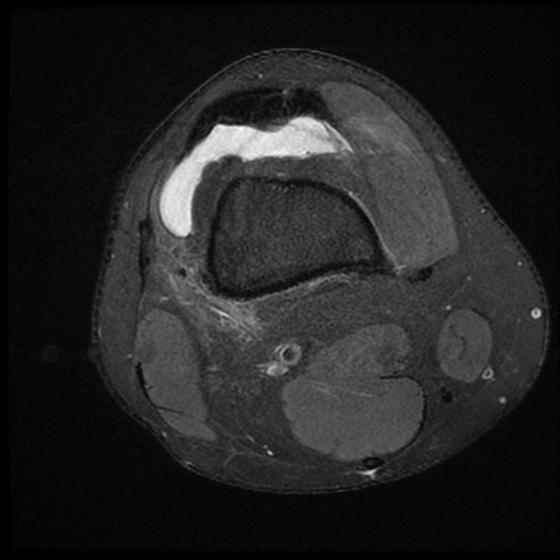 File:ACL acute full thickness tear - deep lateral femoral sulcus sign (Radiopaedia 38594-40740 Axial PD fat sat 5).jpg