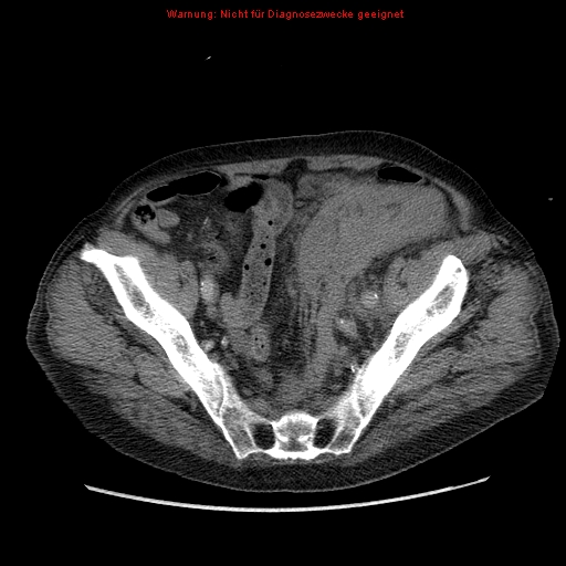 Abdominal aortic aneurysm- extremely large, ruptured (Radiopaedia 19882-19921 Axial C+ arterial phase 64).jpg