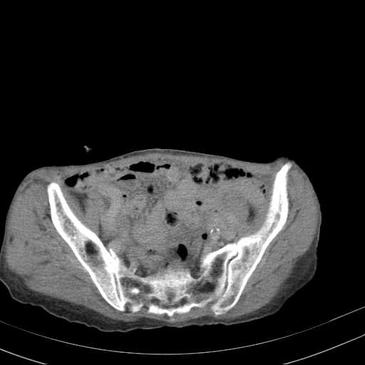 File:Abdominal aortic aneurysm (Radiopaedia 20827-20742 Axial C+ delayed 28).jpg