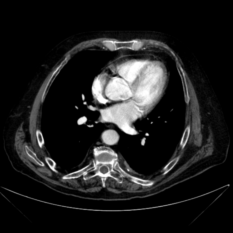 Abdominal aortic aneurysm (Radiopaedia 25855-26001 Axial C+ arterial phase 2).jpg