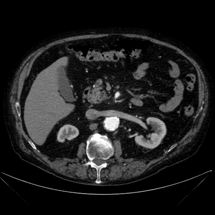 Abdominal aortic aneurysm (Radiopaedia 25855-26001 Axial C+ arterial phase 51).jpg