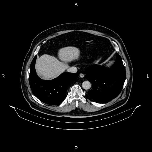 Abdominal aortic aneurysm (Radiopaedia 83094-97462 Axial renal excretory phase 14).jpg