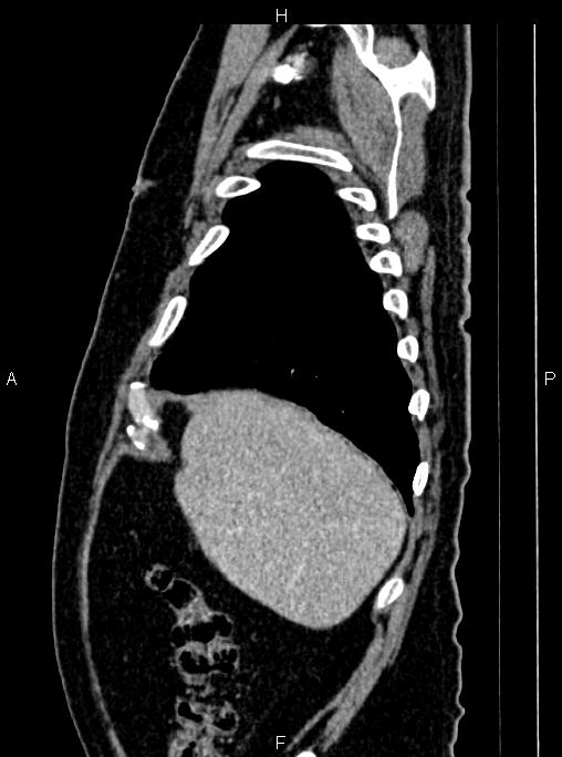 Abdominal aortic aneurysm (Radiopaedia 83094-97462 Sagittal renal cortical phase 23).jpg