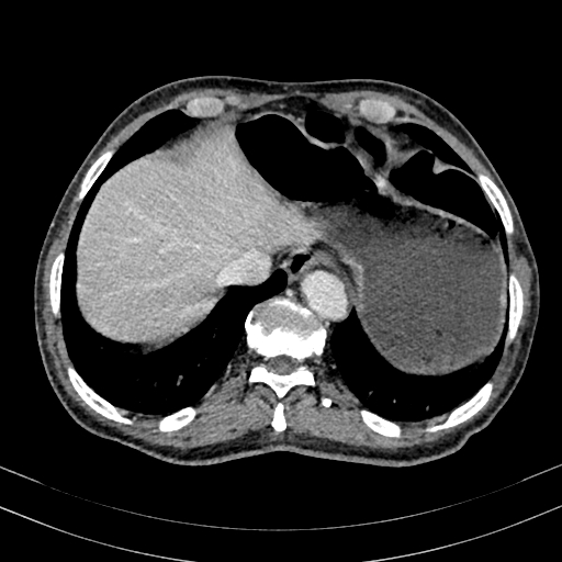 File:Abdominal aortic aneurysm (Radiopaedia 83581-98689 Axial C+ portal venous phase 14).jpg