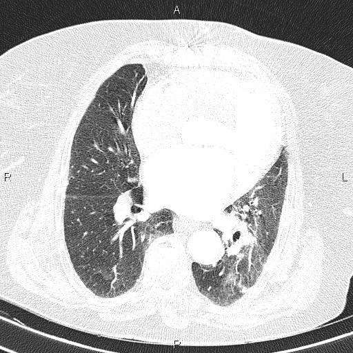 Abdominal aortic aneurysm (Radiopaedia 85063-100606 Axial lung window 39).jpg