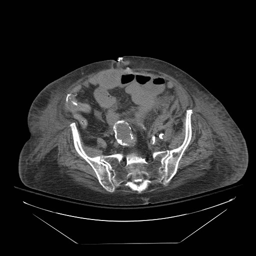 Abdominal aortic aneurysm - impending rupture (Radiopaedia 19233-19247 Axial non-contrast 125).jpg