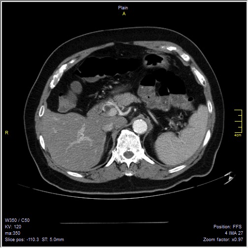 Abdominal aortic aneurysm with thrombus fissuration (Radiopaedia 47340-51926 Axial C+ arterial phase 11).jpg