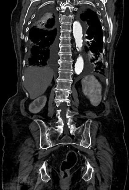 Abdominal aortic aneurysm with thrombus fissuration (Radiopaedia 73192-83919 Coronal C+ arterial phase 66).jpg