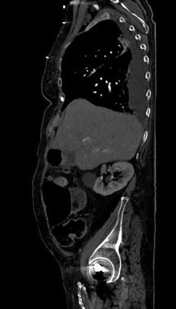 Abdominal aortic aneurysm with thrombus fissuration (Radiopaedia 73192-83919 Sagittal C+ arterial phase 107).jpg