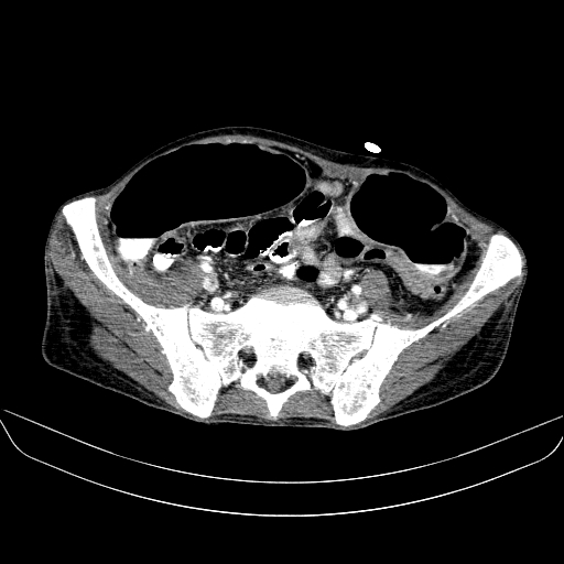 File:Abdominal collection due to previous cecal perforation (Radiopaedia 80831-94320 Axial C+ portal venous phase 154).jpg