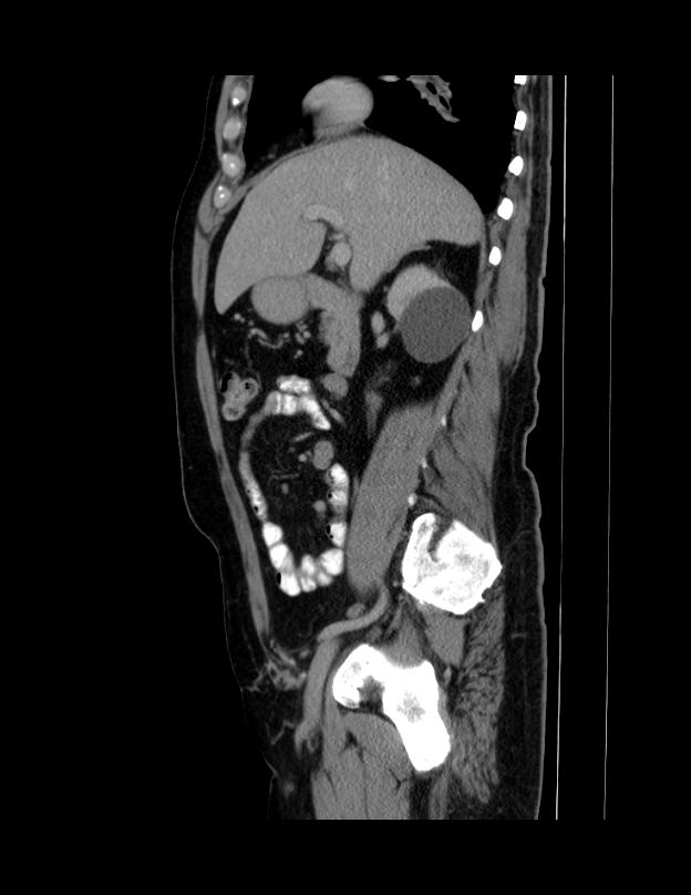 Abdominal lymphoma - with sandwich sign (Radiopaedia 53486-59492 Sagittal C+ portal venous phase 52).jpg