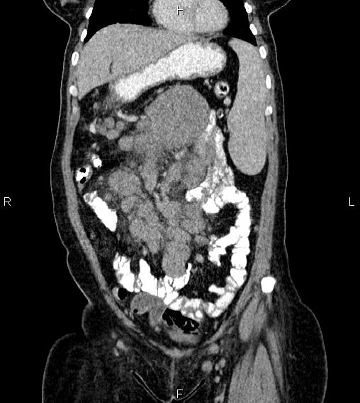 Abdominal lymphoma with sandwich sign (Radiopaedia 84378-99704 Coronal C+ portal venous phase 13).jpg