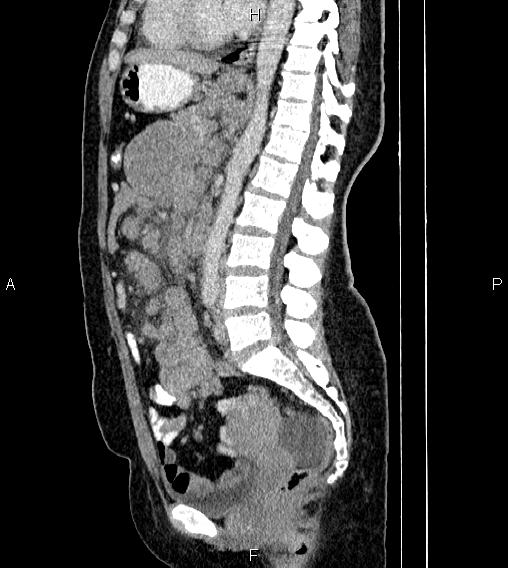 Abdominal lymphoma with sandwich sign (Radiopaedia 84378-99704 Sagittal C+ portal venous phase 49).jpg
