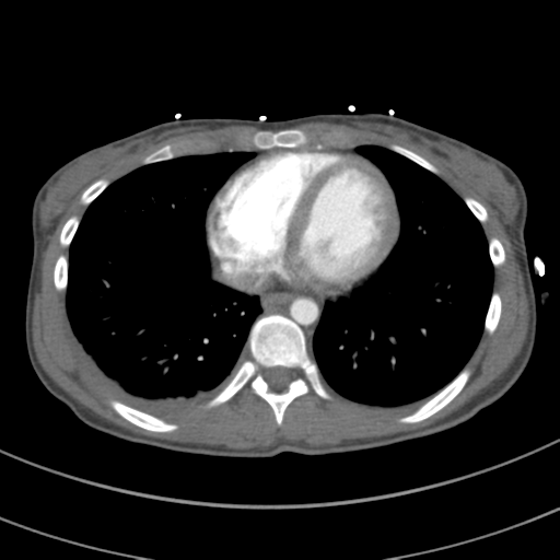 File:Abdominal multi-trauma - devascularised kidney and liver, spleen and pancreatic lacerations (Radiopaedia 34984-36486 Axial C+ arterial phase 60).png