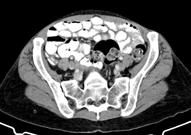 Abdominal wall and retroperitoneal tuberculosis (Radiopaedia 88137-104729 Axial C+ portal venous phase 141).jpg