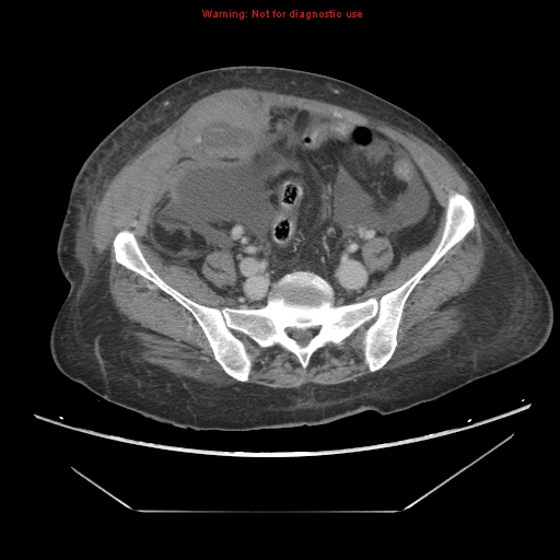 File:Abdominal wall hematoma (Radiopaedia 9427-10112 Axial C+ portal venous phase 78).jpg