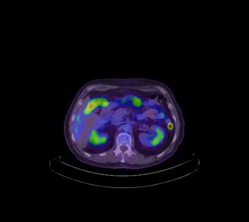 Abdominal wall metastasis from colorectal carcinoma (Radiopaedia 31016-31719 Axial 76).jpg