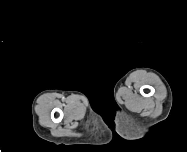 File:Abdominopelvic rhabdomyosarcoma (Radiopaedia 78356-90984 Axial C+ portal venous phase 173).jpg