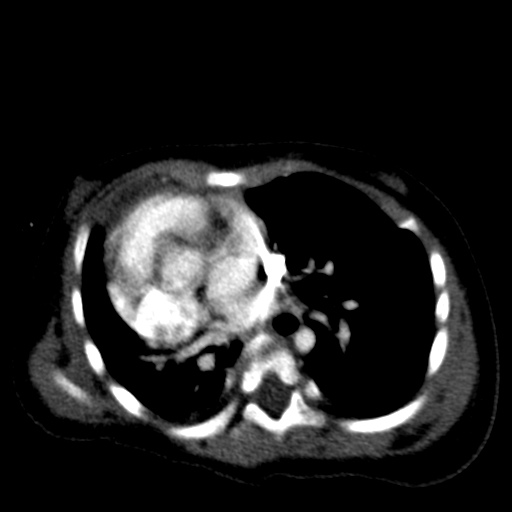 Aberrant left pulmonary artery (pulmonary sling) (Radiopaedia 42323-45435 Axial C+ CTPA 25).jpg