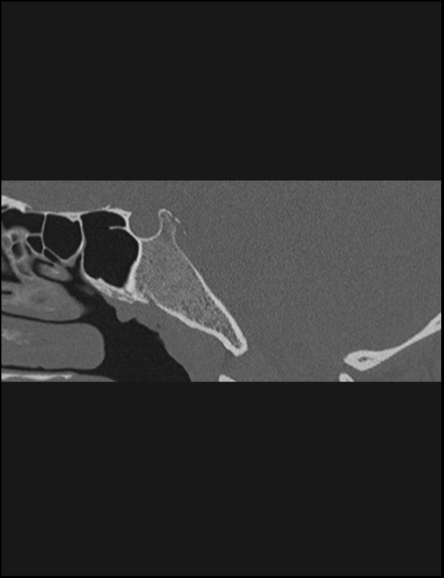 Aberrant right internal carotid artery (Radiopaedia 65191-74198 Sagittal non-contrast 95).jpg