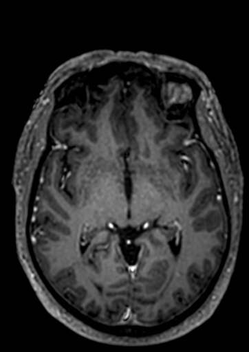 Accessory middle cerebral artery (Radiopaedia 73114-83828 Axial T1 C+ 51).jpg