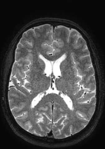 Accessory middle cerebral artery (Radiopaedia 73114-83828 Axial T2 49).jpg