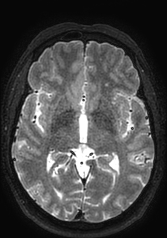 Accessory middle cerebral artery (Radiopaedia 73114-83828 Axial T2 83).jpg