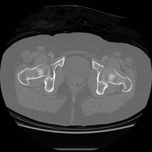 File:Acetabular fracture (Radiopaedia 13193-13212 Axial bone window 40).jpg