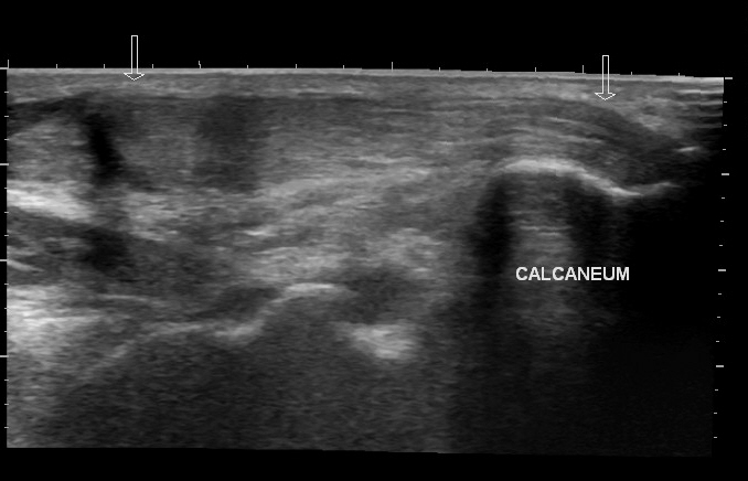 File:Achilles tendon tear (Radiopaedia 18551-18421 E 1).jpg