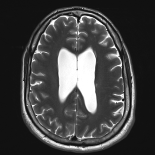 File:Achondroplasia (Radiopaedia 65109-74105 Axial T2 26).png