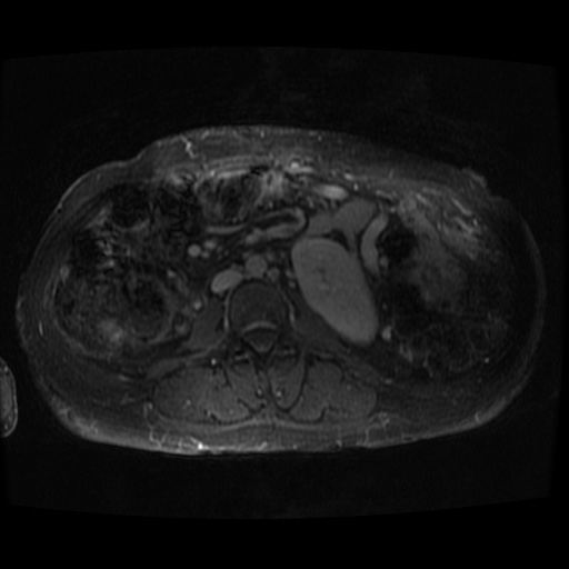 Acinar cell carcinoma of the pancreas (Radiopaedia 75442-86668 D 7).jpg
