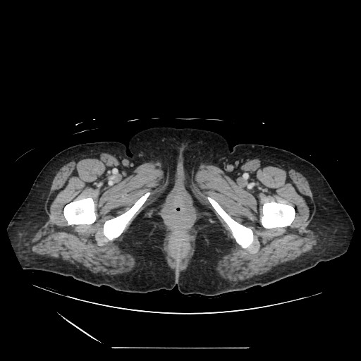 Acinar cell carcinoma of the pancreas (Radiopaedia 75442-86669 Axial C+ portal venous phase 158).jpg