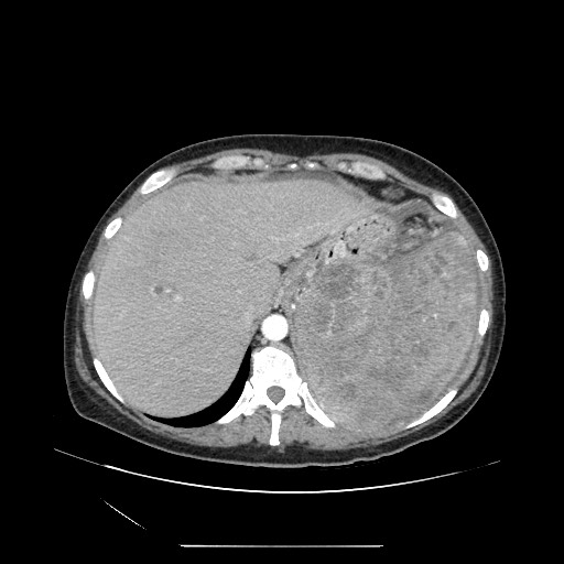 File:Acinar cell carcinoma of the pancreas (Radiopaedia 75442-86669 Axial C+ portal venous phase 23).jpg