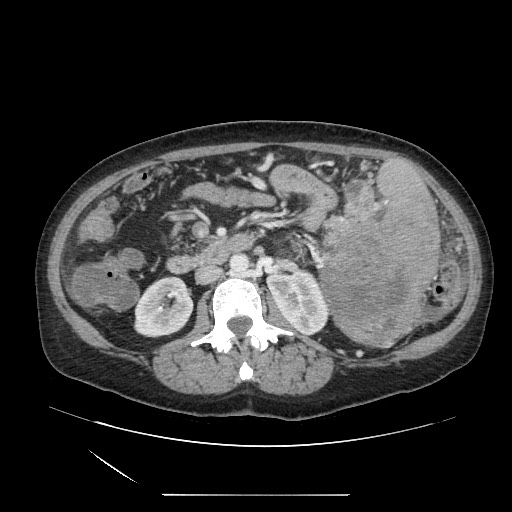 File:Acinar cell carcinoma of the pancreas (Radiopaedia 75442-86669 Axial C+ portal venous phase 65).jpg