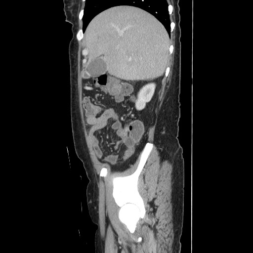 Acinar cell carcinoma of the pancreas (Radiopaedia 75442-86669 Sagittal C+ portal venous phase 54).jpg