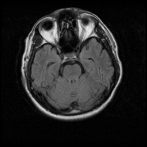 File:Acoustic schwannoma (Radiopaedia 33045-34060 Axial FLAIR 7).png