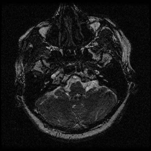File:Acoustic schwannoma (Radiopaedia 33045-34060 Axial T2 11).png