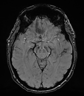 Acoustic schwannoma (Radiopaedia 50846-56358 Axial SWI 41).png