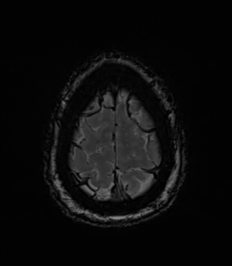 File:Acoustic schwannoma (Radiopaedia 50846-56358 Axial SWI 85).png