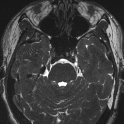 Acoustic schwannoma (translabyrinthine resection) (Radiopaedia 43570-46972 Axial CISS 43).png