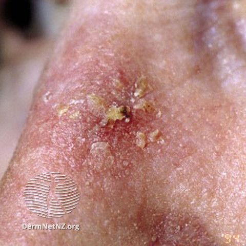 Actinic Keratoses affecting the face (DermNet NZ lesions-ak-face-235).jpg