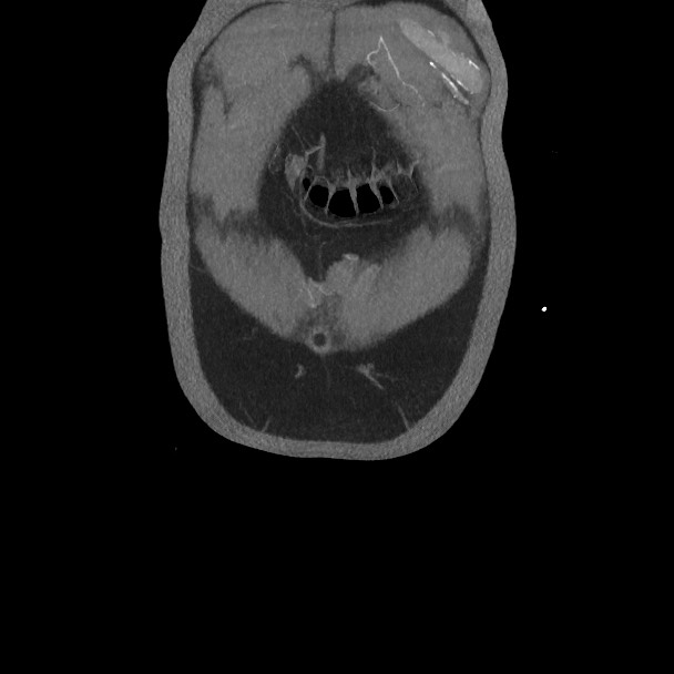 Active colonic bleed on CT (Radiopaedia 49765-55025 Coronal art MIP 10).jpg