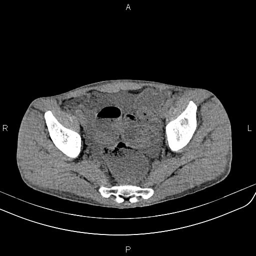 File:Active crohn disease (Radiopaedia 87133-103397 Axial non-contrast 88).jpg