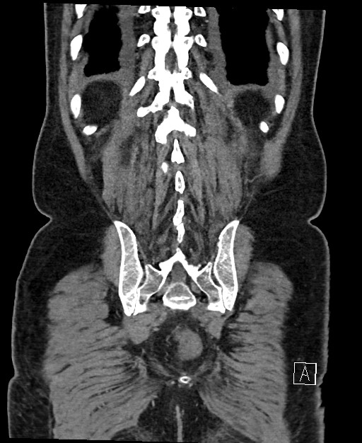 Active lower gastrointestinal bleeding - diverticular (Radiopaedia 61203-69106 Coronal C+ portal venous phase 114).jpg