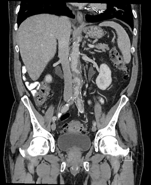 Active lower gastrointestinal bleeding - diverticular (Radiopaedia 61203-69106 Coronal C+ portal venous phase 73).jpg