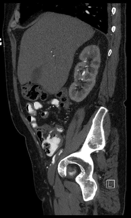 Active lower gastrointestinal bleeding - diverticular (Radiopaedia 61203-69106 Sagittal C+ arterial phase 113).jpg