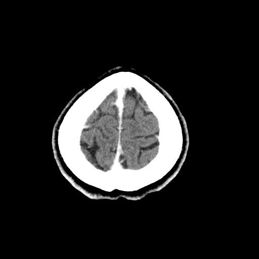 File:Active neurocysticercosis before and after therapy (Radiopaedia 71710-82099 Axial C+ delayed 5).jpg