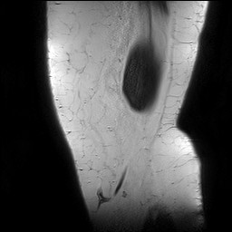Acute-on-chronic transient lateral patellar dislocation with trochlear dysplasia (Radiopaedia 84099-99349 Sagittal PD 8).jpg