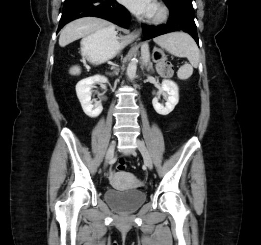 Acute appendicitis, heterotaxy syndrome (Radiopaedia 66884-76202 Coronal C+ portal venous phase 71).jpg