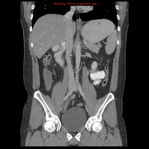 File:Acute appendicitis (Radiopaedia 10498-10973 F 21).jpg